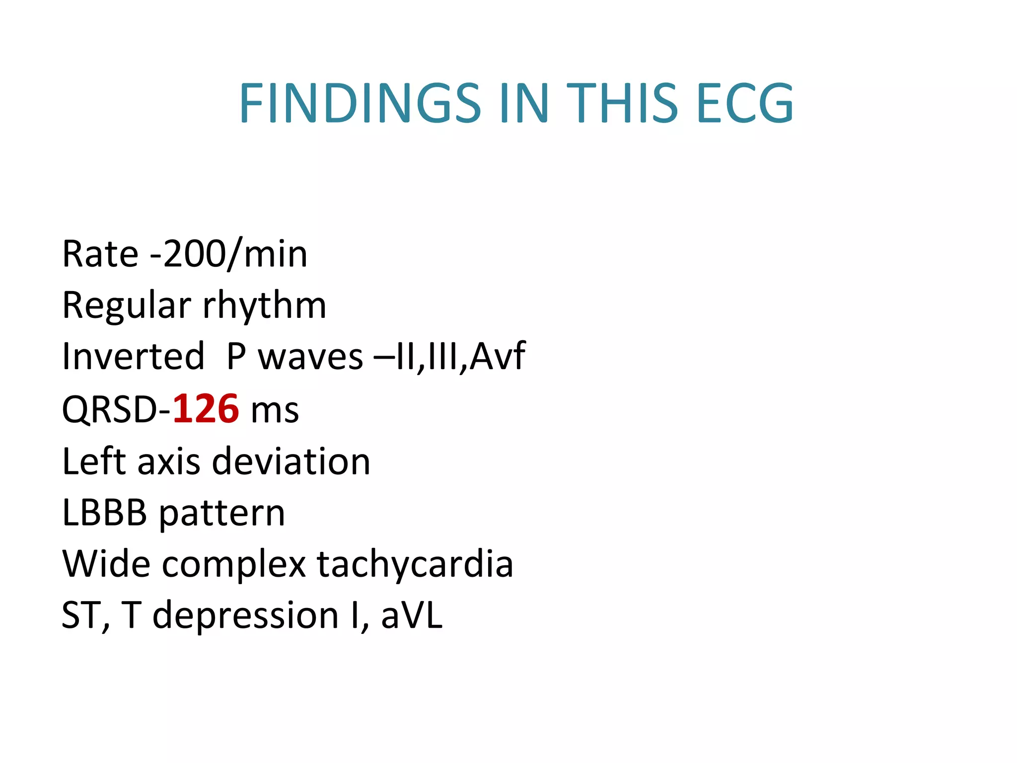 FINDINGS IN THIS ECG
Rate -200/min
Regular rhythm
Inverted P waves –II,III,Avf
QRSD-126 ms
Left axis deviation
LBBB pattern
Wide complex tachycardia
ST, T depression I, aVL