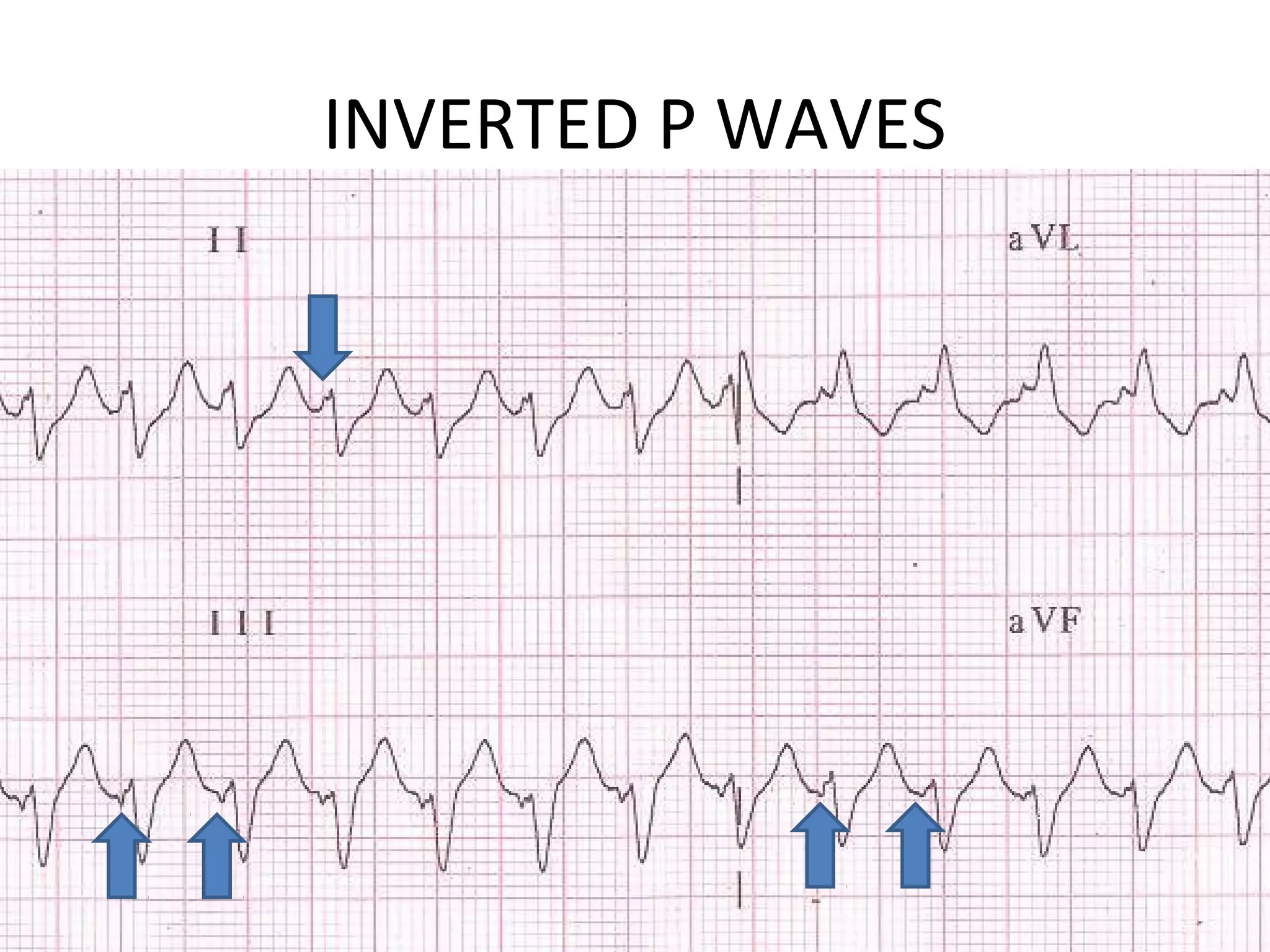 INVERTED P WAVES