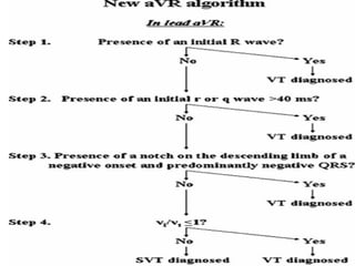 ECG: Wide Complex Tachycardia | PPT