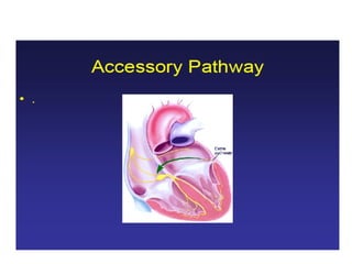 ECG: Wide Complex Tachycardia | PPT