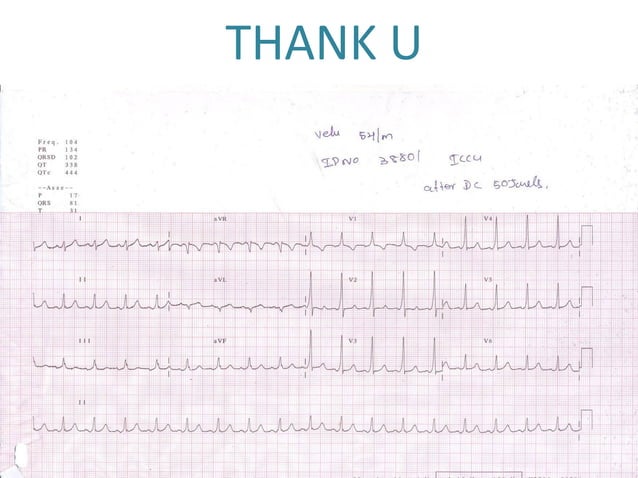 ECG: Wide Complex Tachycardia | PPT