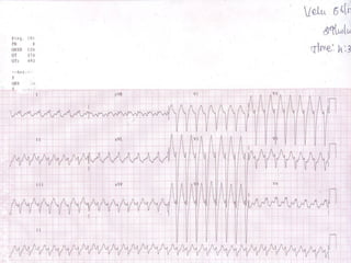 ECG: Wide Complex Tachycardia | PPT