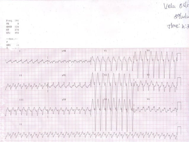 ECG: Wide Complex Tachycardia | PPT