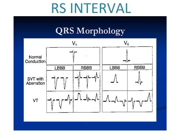 ECG: Wide Complex Tachycardia | PPT