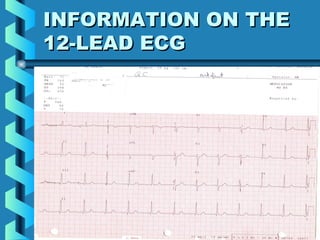 17
INFORMATION ON THEINFORMATION ON THE
12-LEAD ECG12-LEAD ECG
 