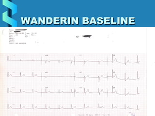 32
WANDERIN BASELINEWANDERIN BASELINE
 