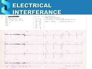 34
ELECTRICALELECTRICAL
INTERFERANCEINTERFERANCE
 