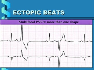 43
ECTOPIC BEATSECTOPIC BEATS
 