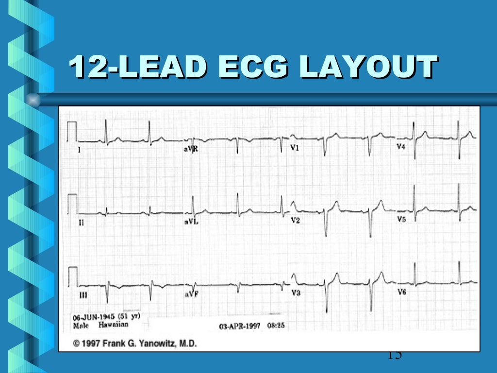  ecg made easy 