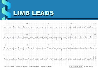 22
LIMB LEADSLIMB LEADS
 