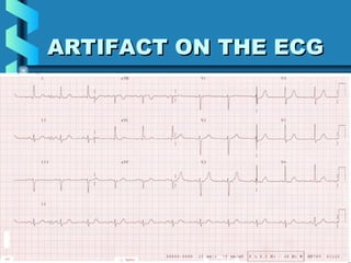 30
ARTIFACT ON THE ECGARTIFACT ON THE ECG
 