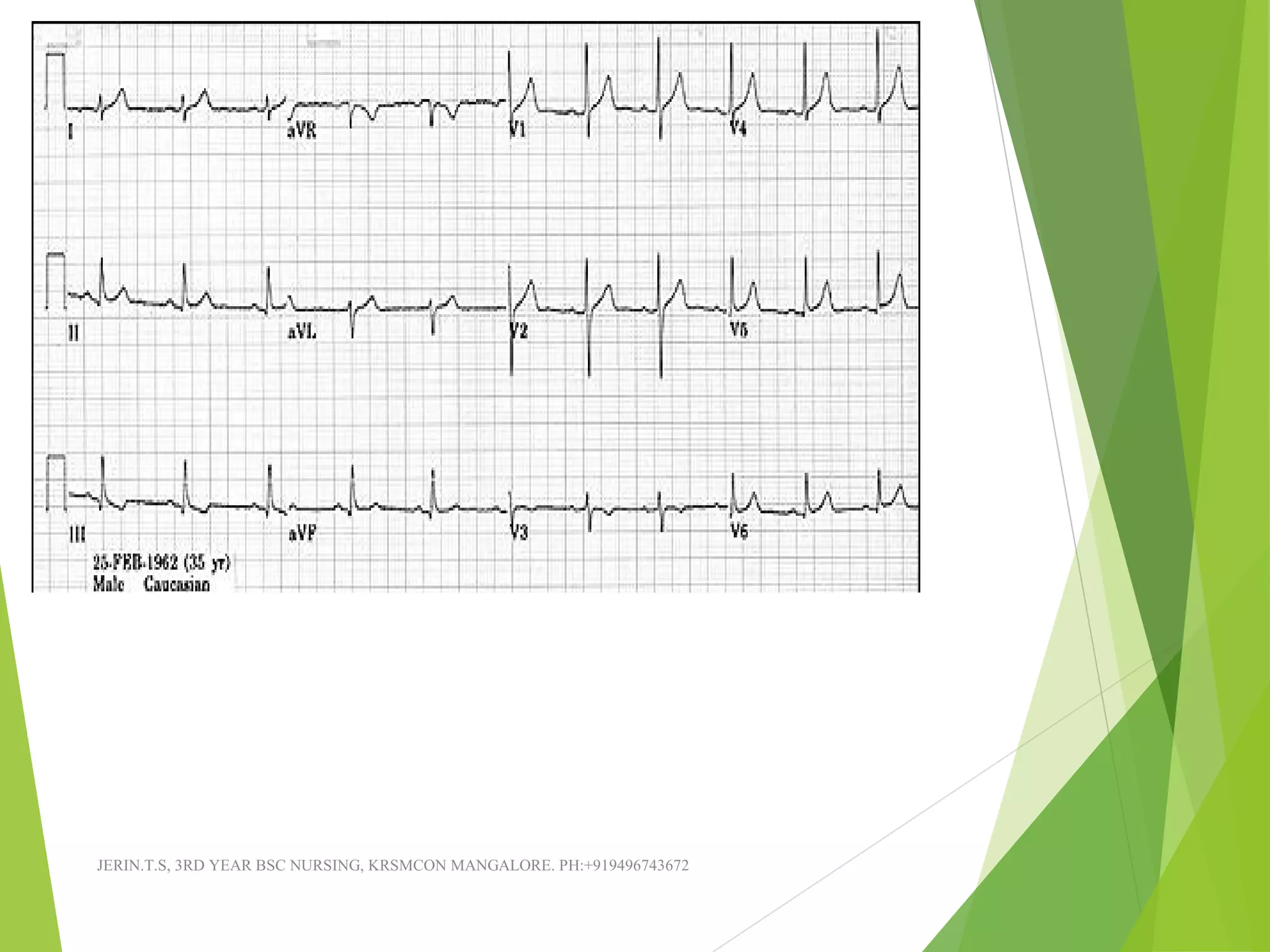 Simple Approach Ecg Ecg made easy ppt | PPT
