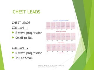 CHEST LEADS
CHEST LEADS
COLUMN III
 R wave progression
 Small to Tall
COLUMN IV
 R wave progression
 Tall to Small
JERIN.T.S, 3RD YEAR BSC NURSING, KRSMCON
MANGALORE. PH:+919496743672
 