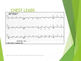 CHEST LEADS
JERIN.T.S, 3RD YEAR BSC NURSING, KRSMCON MANGALORE. PH:+919496743672
 