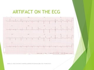 ARTIFACT ON THE ECG
JERIN.T.S, 3RD YEAR BSC NURSING, KRSMCON MANGALORE. PH:+919496743672
 