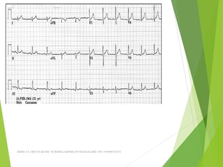 JERIN.T.S, 3RD YEAR BSC NURSING, KRSMCON MANGALORE. PH:+919496743672
 