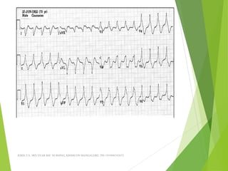 JERIN.T.S, 3RD YEAR BSC NURSING, KRSMCON MANGALORE. PH:+919496743672
 