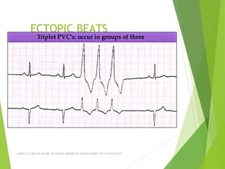 ECTOPIC BEATS
JERIN.T.S, 3RD YEAR BSC NURSING, KRSMCON MANGALORE. PH:+919496743672
 
