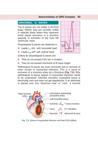 Ecg made easy | PDF