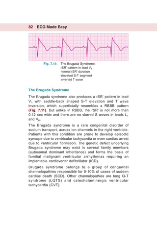 Ecg made easy | PDF