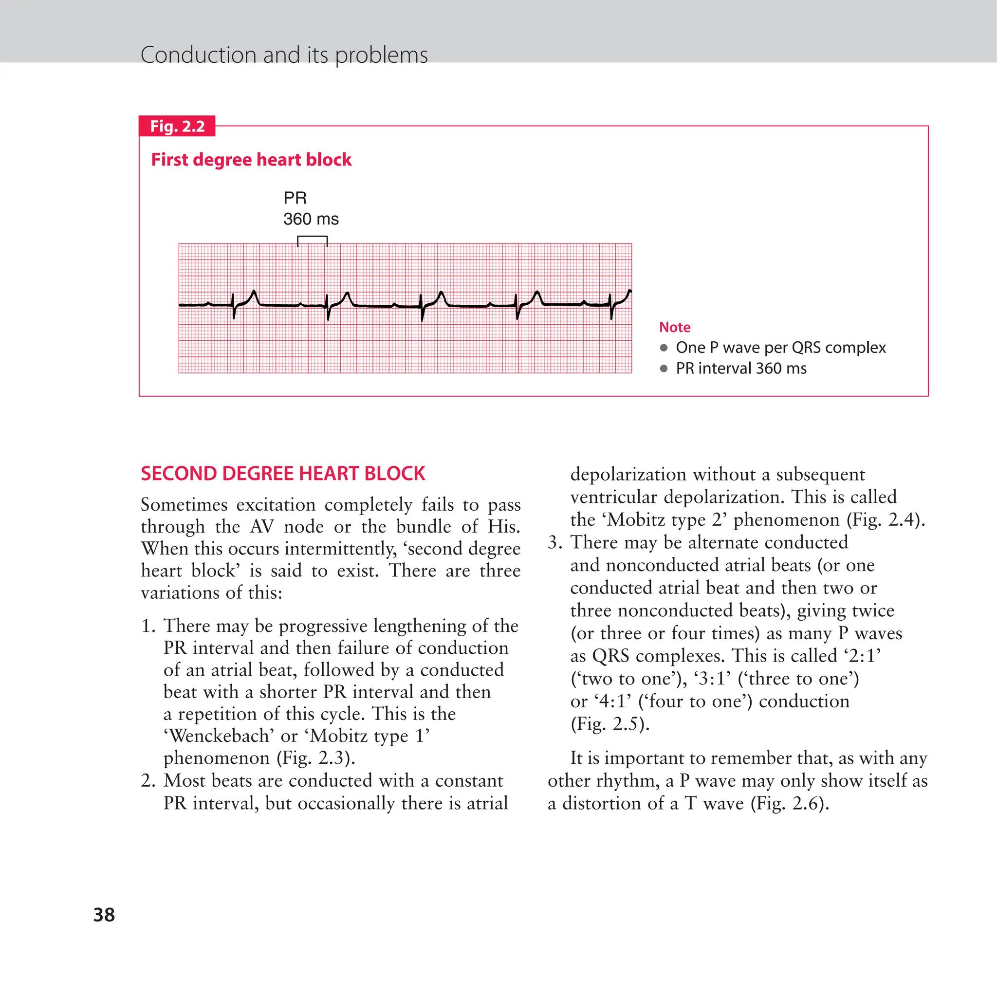 The ECG made easy guide. Guide on how to read ECG's quick and ...