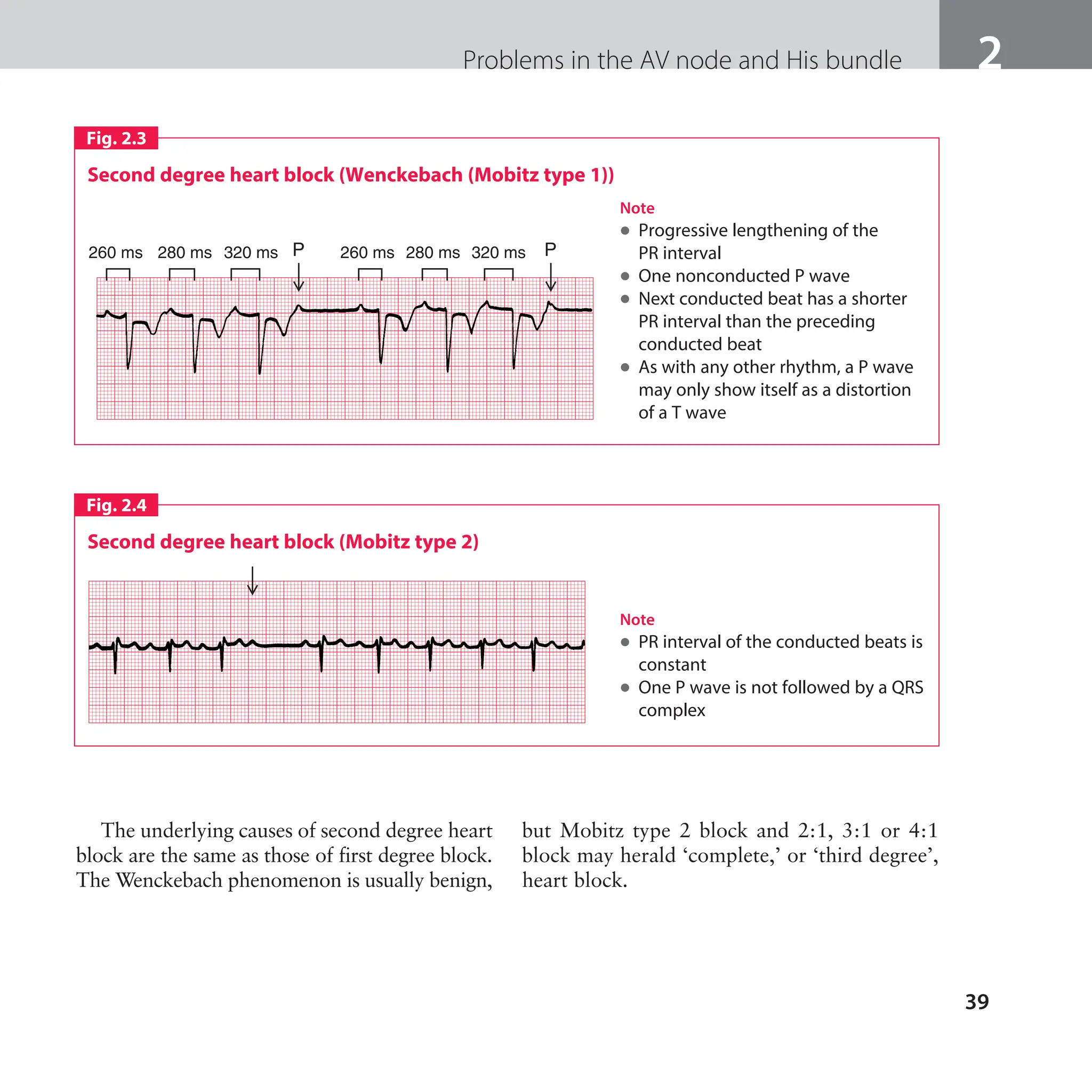 The ECG made easy guide. Guide on how to read ECG's quick and ...