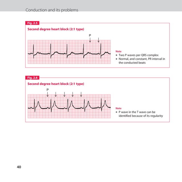 The ECG made easy guide. Guide on how to read ECG's quick and ...