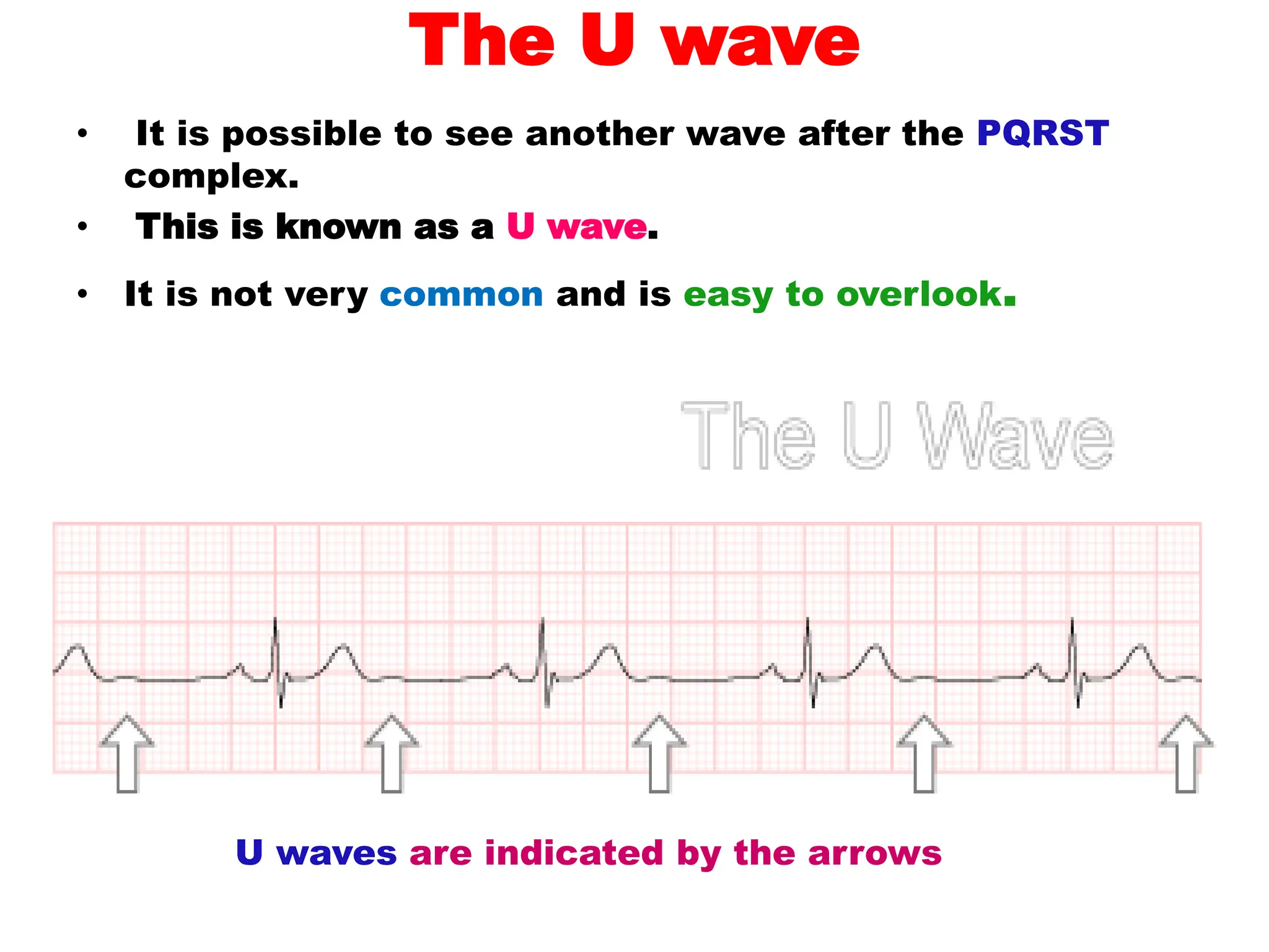 The U wave
• It is possible to see another wave after the PQRST
complex.
• This is known as a U wave.
• It is not very common and is easy to overlook.
U waves are indicated by the arrows
 