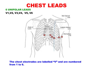 CHEST LEADS
6 UNIPOLAR LEADS
V1,V2, V3,V4, V5, V6
The chest electrodes are labelled “V” and are numbered
from 1 to 6.
 