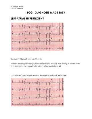 Dr.Pokhrel, Bharat
CVS – ECG BASICS
ECG- DIAGNOSIS MADE EASY
LEFT ATRIAL HYPERTROPHY
S wave in V2 plus R wave in V5 > 35.
The left atrial hypertrophy is noticaeable by a P wave that is long in lead II, with
an increase in the negative terminal deflection in lead V1
LEFT VENTRICULAR HYPERTROPHY AND LEFT ATRIAL ENLARGEMENT
 