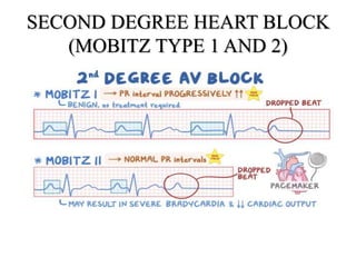 ECG MONITORING AND ECG CHANGES OF INTRAOPERATIVE MYOCARDIAL.pptx