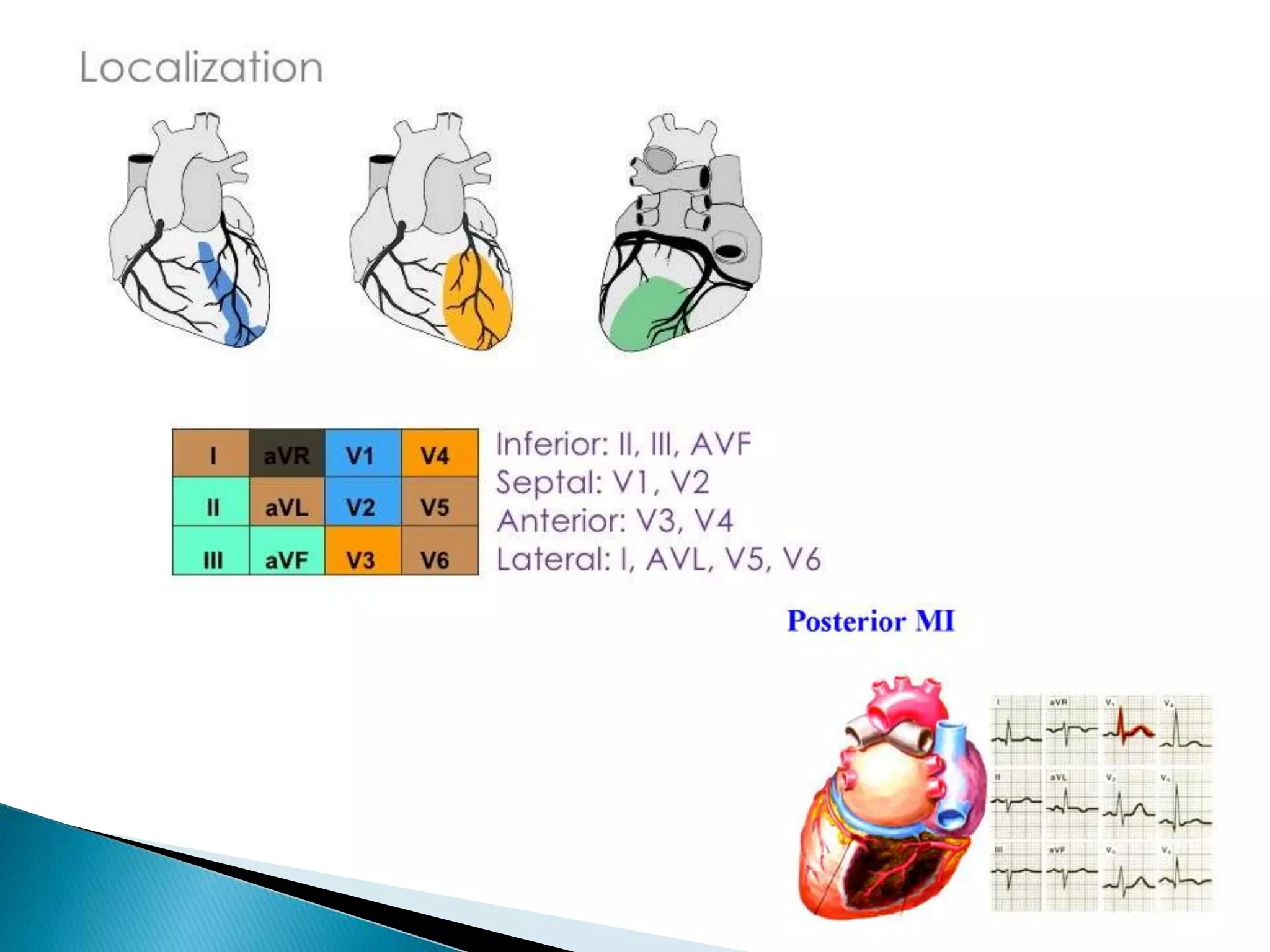 ECG Changes in Myocardial Infarction | PPTX