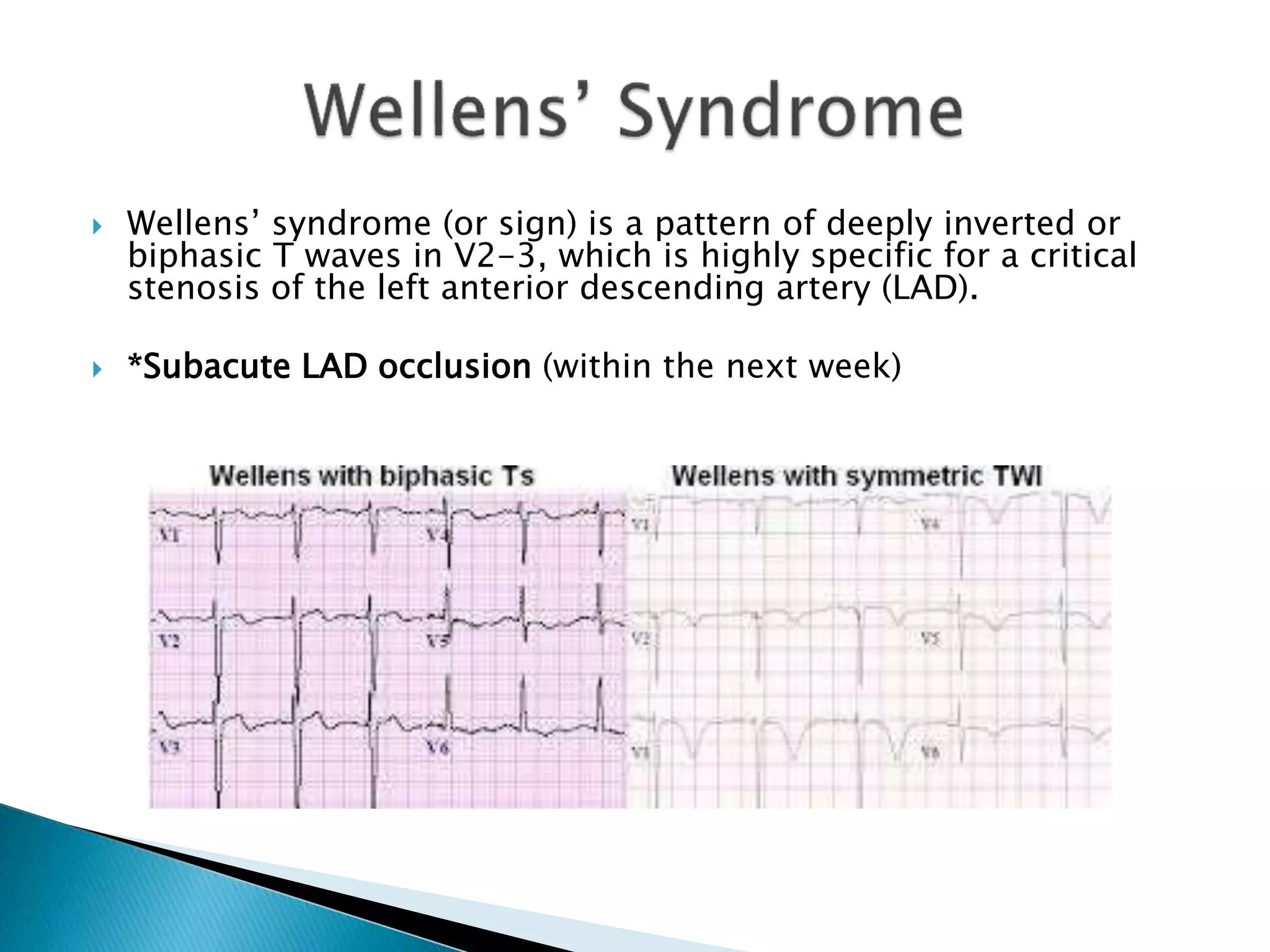 ECG Changes in Myocardial Infarction | PPTX