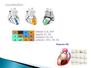 Localizing Mi ECG Changes in Myocardial Infarction | PPTX