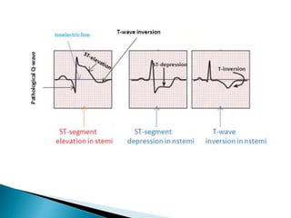 ECG Changes in Myocardial Infarction | PPTX