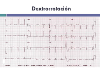 Dextrorrotación 
 