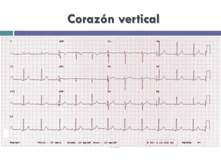 Corazón vertical 
 
