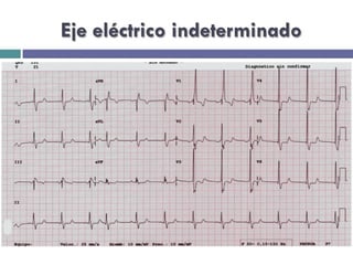 Eje eléctrico indeterminado 
 