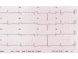 Electrocardiograma Normal