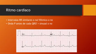 Ritmo cardiaco
• Intervalos RR similares o no? Rítmico o no
• Onda P antes de cada QRS? = sinusal o no
 