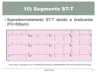 10) Segmento ST-T
 Supradesnivelamento ST-T devido a bradicardia

(FC<50bpm):

(Fonte: http://1.bp.blogspot.com/-Yn-X88IRPE0/Twhpwg1Sp_I/AAAAAAAABHk/VGKI1Vrt18U/s1600/first+ECG.jpg)

Catarina Rua

16

 