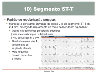 10) Segmento ST-T
 Padrão de repolarização precoce:
 Marcada e constante elevação do ponto J e do segmento ST-T de
2-4 mm, emergindo diretamente do ramo descendente da onda R:
 Ocorre nas derivações precordiais anteriores
(mais acentuada septal ou lateralmente)
e / ou derivações III e aVF
 Geralmente as ondas T
também são de
amplitude elevada
 Mais frequente
no sexo masculino
e jovens

(Fonte: http://img.medscape.com/fullsize/migrated/530/509/mc530509.fig1.jpg
Catarina Rua

17

 