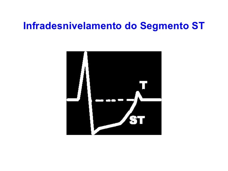 ECG NORMAL ECG NORMAL
