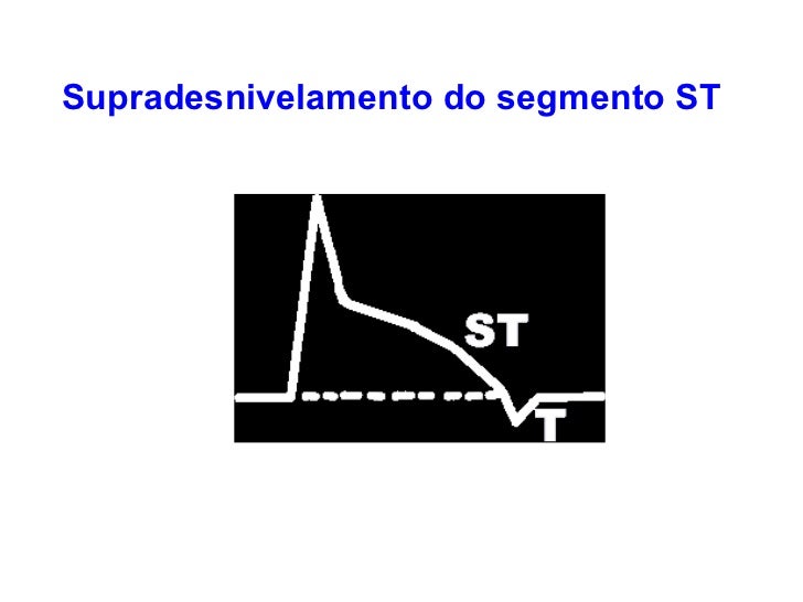 O Que Significa Supradesnivelamento Do Segmento St