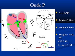 Onde POnde P
 Axe: 0-90°Axe: 0-90°
 Durée<0.11secDurée<0.11sec
 Ampl:<2.5mmAmpl:<2.5mm
 Morpho: +D2,Morpho: +D2,
D1D1
+V2 à V6+V2 à V6
+,- ou +/- V1+,- ou +/- V1
 