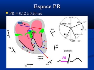 Espace PREspace PR
 PR = 0.12 à 0.20 secPR = 0.12 à 0.20 sec
 