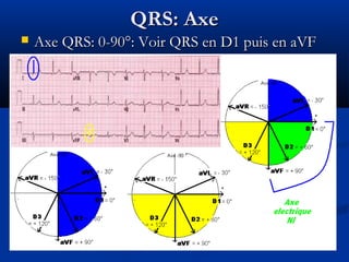 QRS: AxeQRS: Axe
 Axe QRS: 0-90°: Voir QRS en D1 puis en aVFAxe QRS: 0-90°: Voir QRS en D1 puis en aVF
 