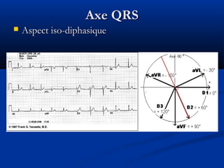 Axe QRSAxe QRS
 Aspect iso-diphasiqueAspect iso-diphasique
 
