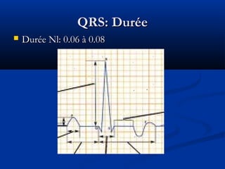 QRS: DuréeQRS: Durée
 Durée Nl: 0.06 à 0.08Durée Nl: 0.06 à 0.08
 
