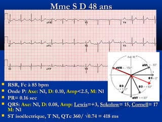 Mme S D 48 ansMme S D 48 ans
 RSR, Fc à 85 bpmRSR, Fc à 85 bpm
 Onde P:Onde P: Axe:Axe: Nl,Nl, D:D: 0.10,0.10, AmpAmp<2.5,<2.5, M:M: NlNl
 PR= 0.16 secPR= 0.16 sec
 QRS:QRS: Axe:Axe: Nl,Nl, D:D: 0.08,0.08, Amp:Amp: LewisLewis=+3,=+3, SokolowSokolow= 15,= 15, CornellCornell= 17= 17
M:M: NlNl
 ST isoélectrique, T Nl, QTc 360/ √0.74 = 418 msST isoélectrique, T Nl, QTc 360/ √0.74 = 418 ms
 